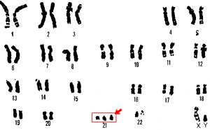 21_trisomy_-_Down_syndrome